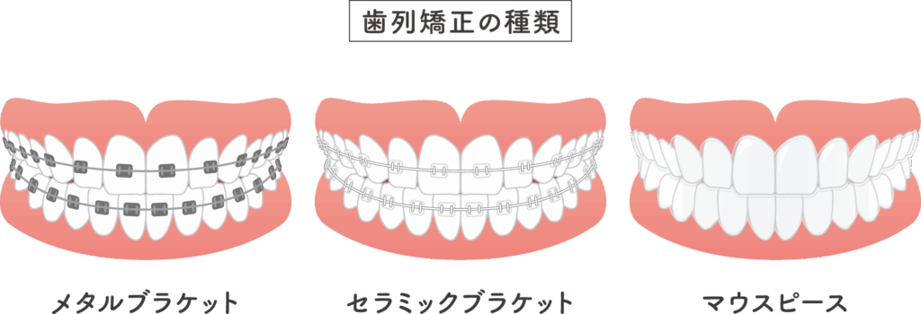 千葉県袖ケ浦市のホームデンタルクリニック(JR内房線長浦駅徒歩5分)では、クリアブラケットを用いた目立ちにくい矯正治療で、美しく自然な歯並びへ導きます。