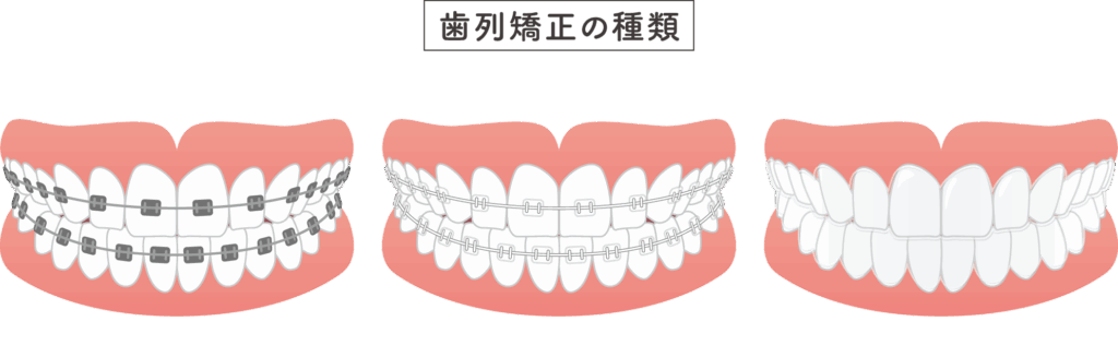千葉県袖ケ浦市のホームデンタルクリニック（JR内房線長浦駅徒歩5分）では、クリアブラケットを用いた目立ちにくい矯正治療で、美しく自然な歯並びへ導きます。