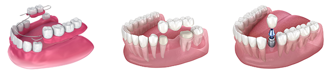 千葉県袖ケ浦市のホームデンタルクリニック（JR内房線長浦駅徒歩5分）では、精密な診査・診断に基づくインプラント治療を提供し、失った歯の機能と自然な見た目の回復をサポートしています。