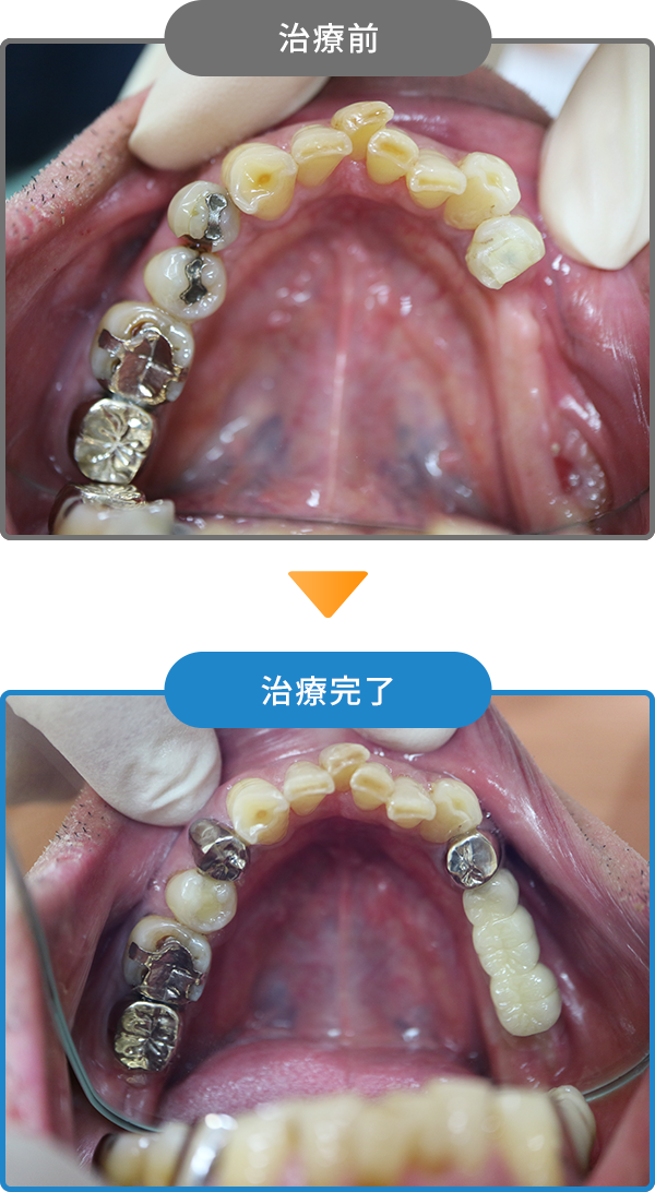 インプラントの治療例02
