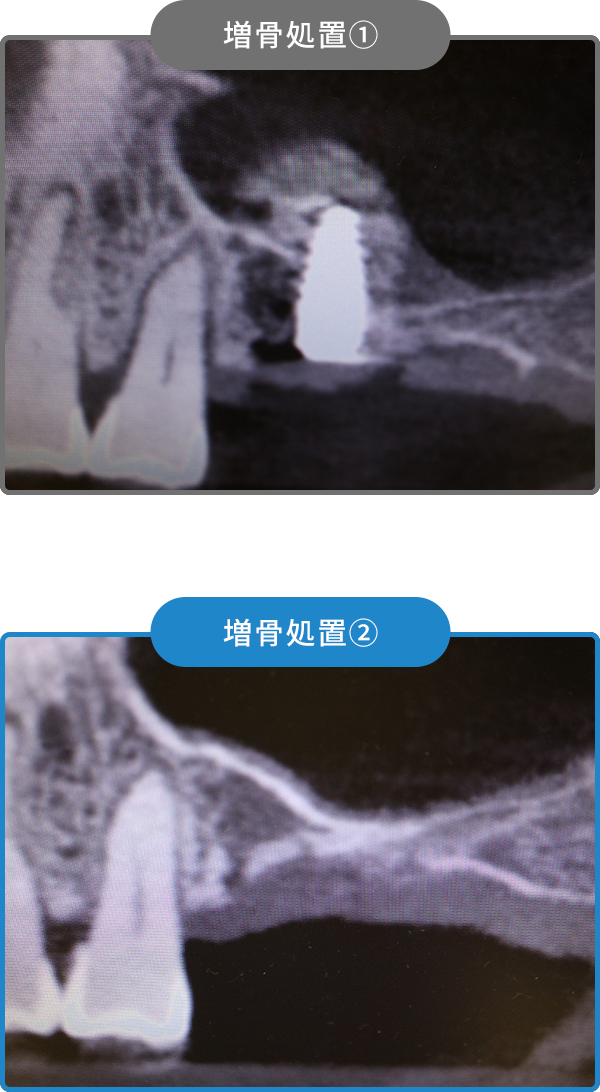 インプラントの治療例04