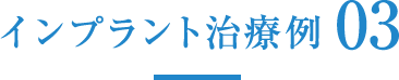 インプラントの治療例03