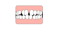 空隙歯列（くうげきしれつ）