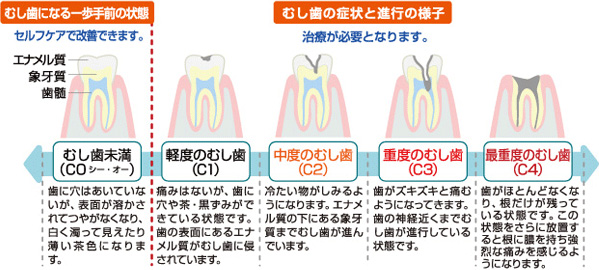 虫歯の進行の様子
